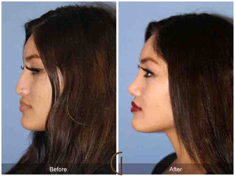 Teen Rhinoplasty Before & After Image