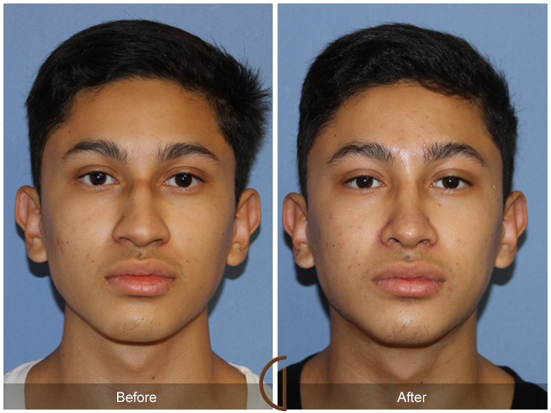 Teen Rhinoplasty Before & After Image