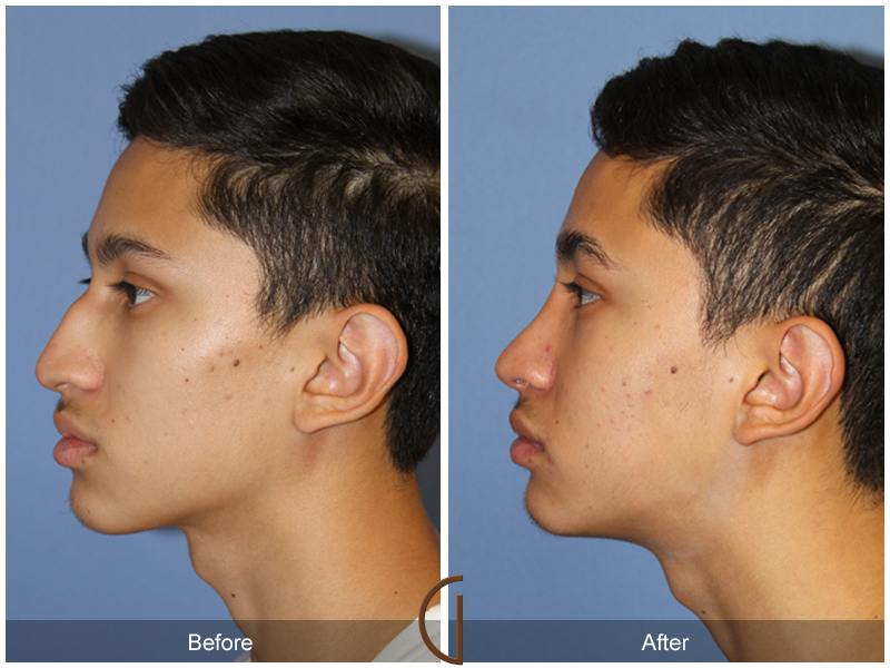 Teen Rhinoplasty Before & After Image