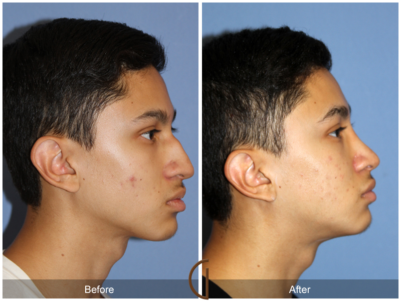 Teen Rhinoplasty Before & After Image