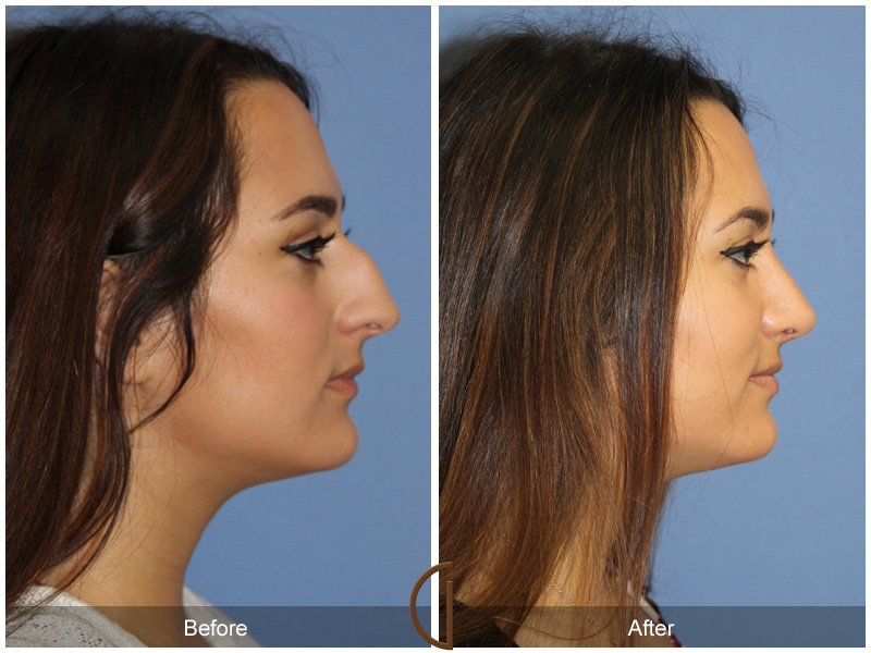 Teen Rhinoplasty Before & After Image