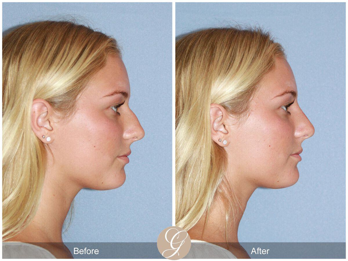 Tip Rhinoplasty  Before & After Image