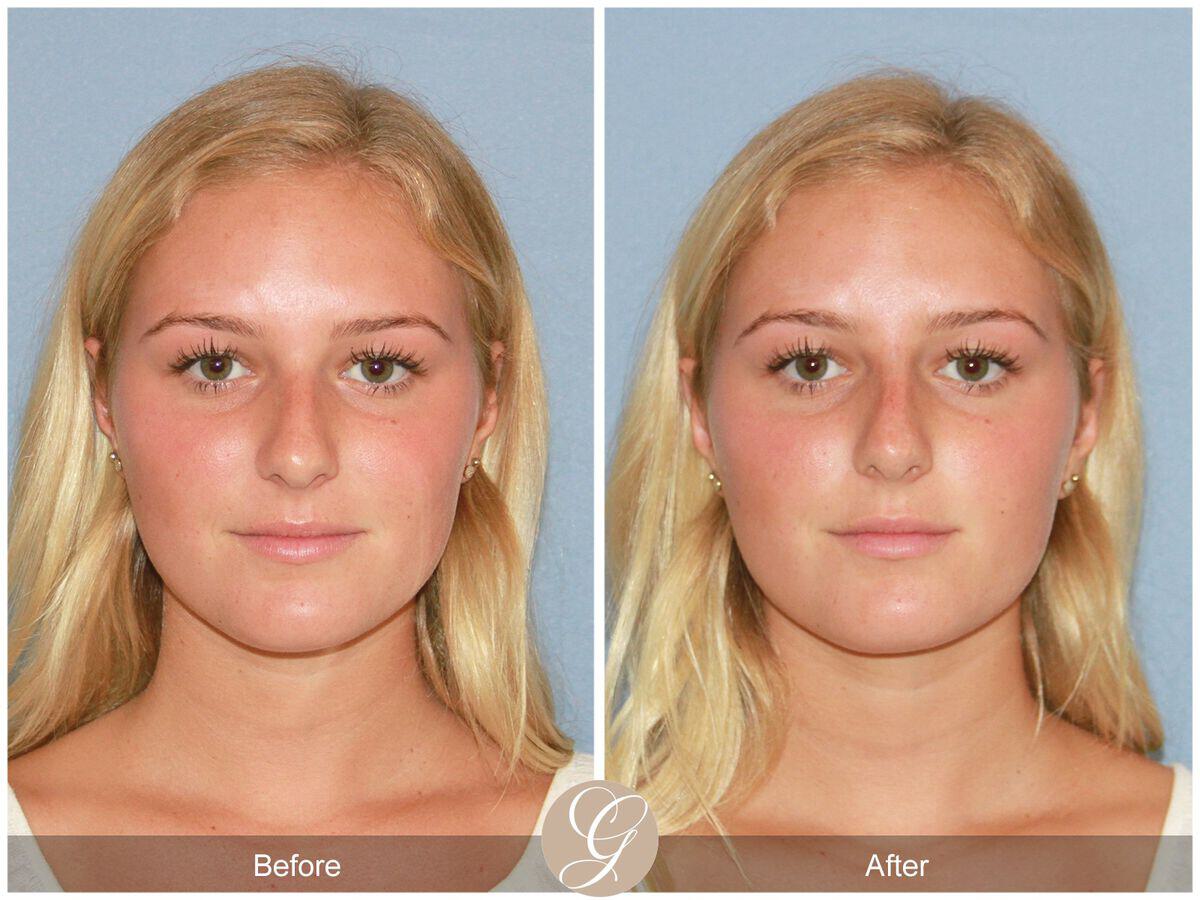 Tip Rhinoplasty  Before & After Image