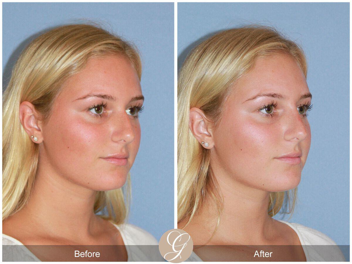 Tip Rhinoplasty  Before & After Image